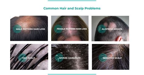 Hair Scalp Conditions At Jacqueline Carter Blog