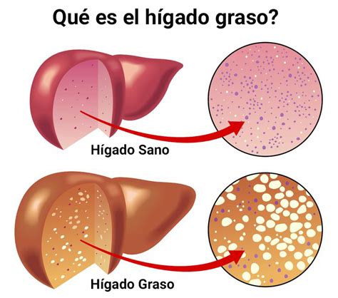 Qué es el hígado graso