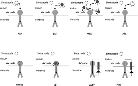 Various Mechanisms Of Svt Diagrammatic Representation Of Various