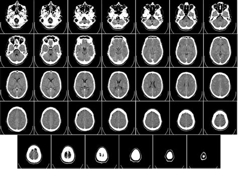 How To Read A Head CT The Radiology Blog