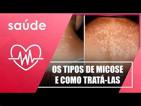 Descubra quais são os tipos de micose e como tratá las dr Werick