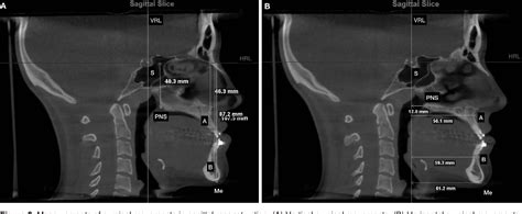 Figure From How Does Bimaxillary Orthognathic Surgery Change