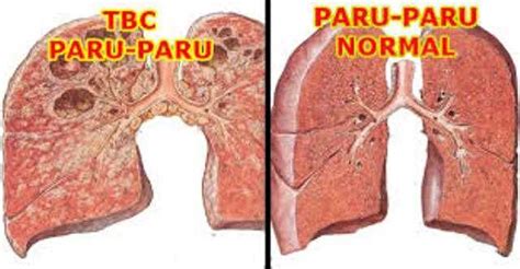 Tuberkulosis Tbc Gejala Pengobatan Dan Pencegahannya — Seruji