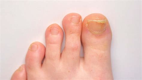 Thickened Toenails Round House Podiatry