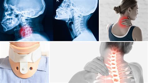 Neck Injuries Pain And Spine Specialists