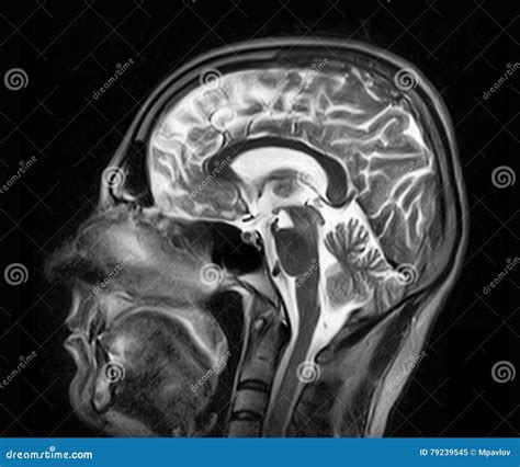 Magnetic Resonance Imaging Of The Brain Stock Image Image Of