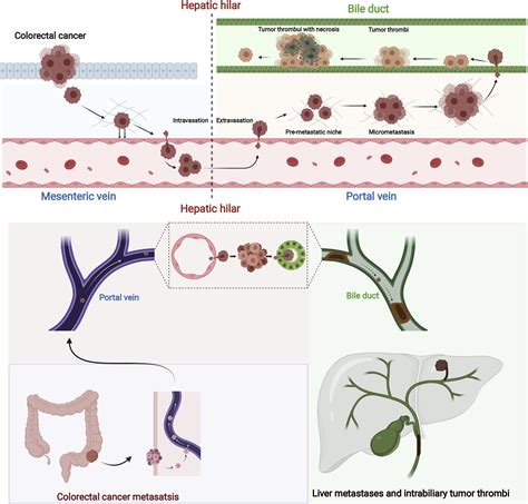 Imaging And Clinical Features Of Colorectal Liver Metastases With