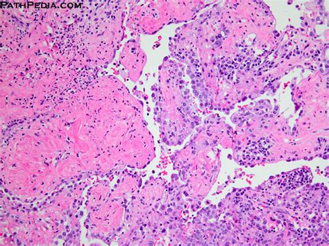 5 LU046 5 Sclerosing Hemangioma Of Lung Pathpedia Flickr