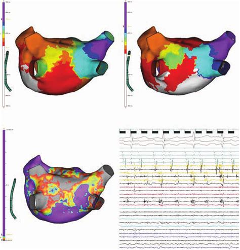 Left Atrial Electroanatomical Maps And Intracardiac Electrograms A