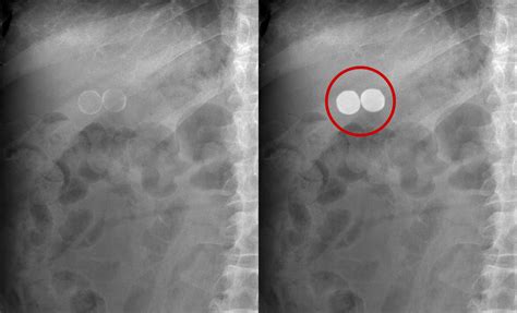 Abdominal X Ray Gallery Calcification Calcified Gallstones