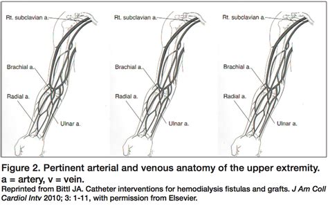 Should You Do A Radial Artery Cath In Patients Needing Cabg Or Dialysis Cath Lab Digest Hmp