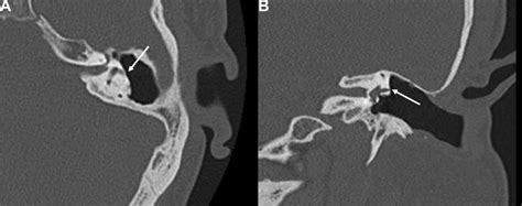 Cholesteatoma Causing A Horizontal Semicircular Canal Fistula Hamid Djalilian Michela