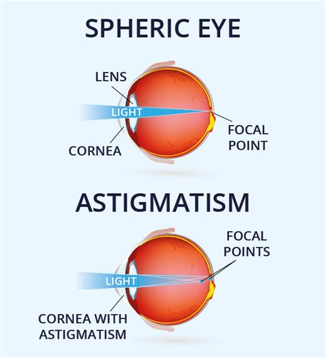 Astigmatismo: cause, sintomi e cure | Vision Direct