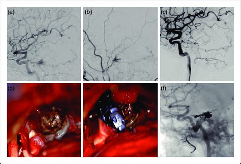 Case Patient A Left Internal Carotid Artery Ica Angiogram