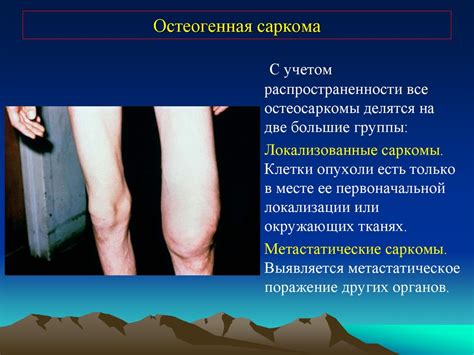 Опухоли костей и суставов - презентация онлайн
