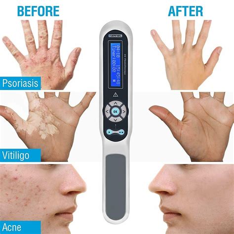 Kn4003b 311nm Narrowband Uv Uvb Phototherapy For Vitiligo Treatment