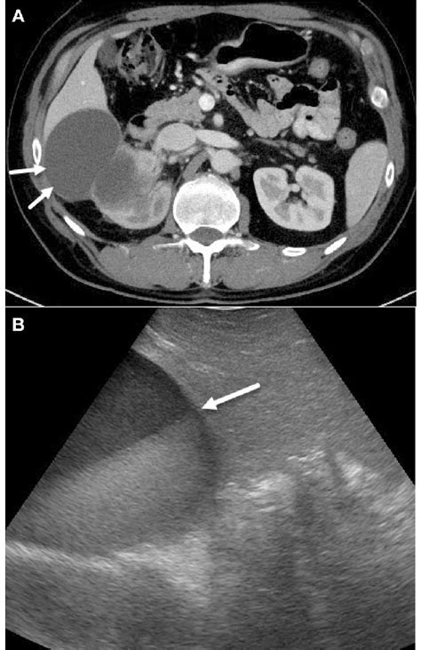 A 59 Year Old Man With Anal Squamous Cell Carcinoma With Secondary