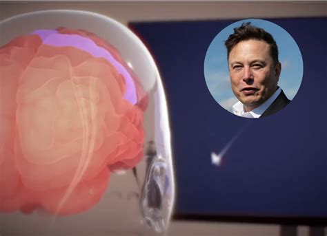 Elon Musk S Neuralink Implanted Its Brain Chip In A Human Being For The First Time Time News