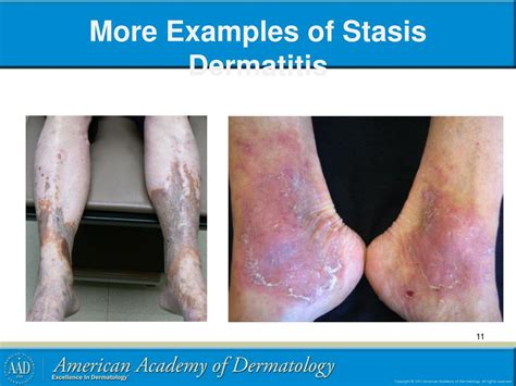 Ppt Stasis Dermatitis And Leg Ulcers Powerpoint Presentation Free