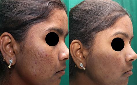 Professional Microneedling Acne Scars Treatment In Brisbane