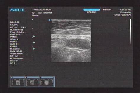 Vietnamese Medic Ultrasound Case 230contralateral Breast Cancer Cbc