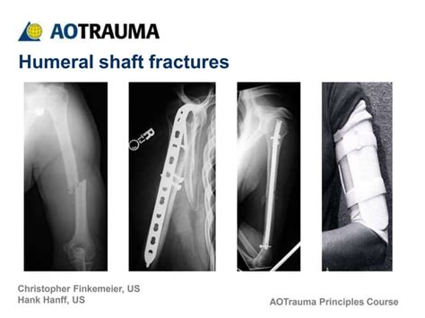 humerus shaft pptx