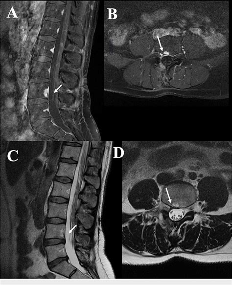 Figure From Lumbar Epidural Cavernous Hemangioma A Case Report And