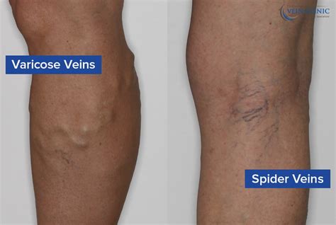 Our Approach To Spider Vein Treatment Vein Clinic Perth