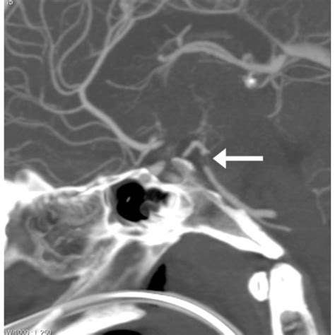 Computed Tomography Angiography 2d Sagittal Reconstructed Image Download Scientific Diagram