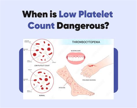 Low Platelet Count When Should You Worry By Dr Karunakumar Medium