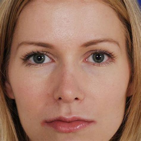 Causes Of Flared Nostrils After A Rhinoplasty Houston Facial Surgeon