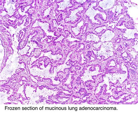 Pathology Outlines Adenocarcinoma Overview