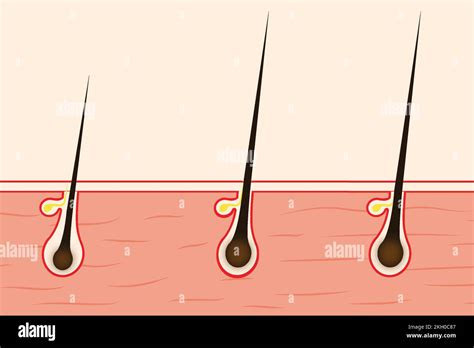 Hair Growing Concept With A Human Skin Illustration Hair Follicles