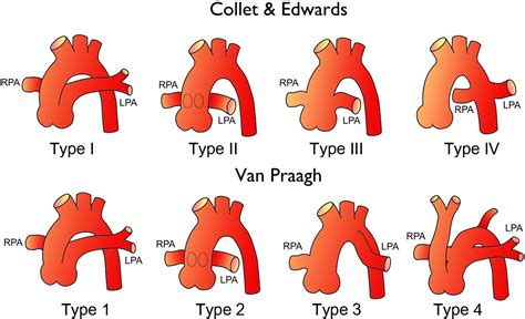 3d Mdct Angiography For The Preoperative Assessment Of Truncus