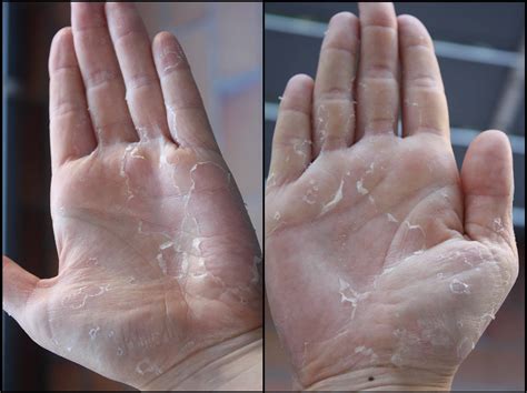 How to get rid of peeling skin: 7 amazing tips - eHome Remedies