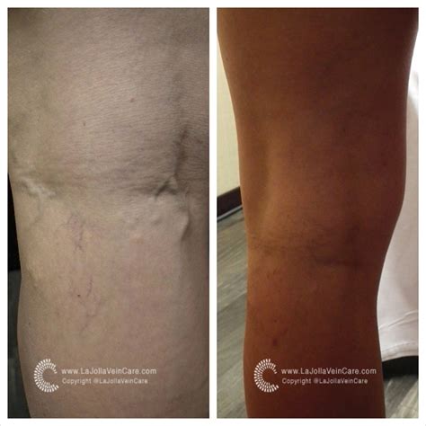 Varicose Vein Treatment Before and After