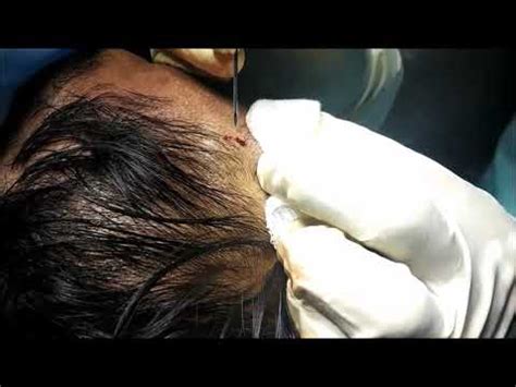 Mumbai Patient FUE Hair Transplant Without Shaving Elegance Clinic