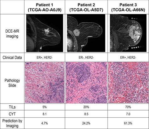 Magnetic Resonance Imaging And Molecular Features Associated With Tumor