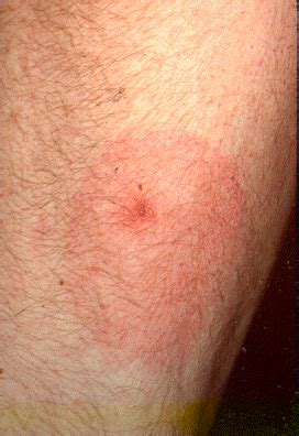 Lyme Disease - Tiny Ticks, Huge Problems - Skin Site