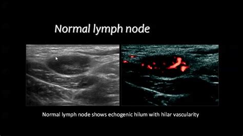 Lymphoma Lymph Nodes Ultrasound