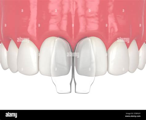 3d Render Of Diastema Closure Using Bonding Procedure Part 4