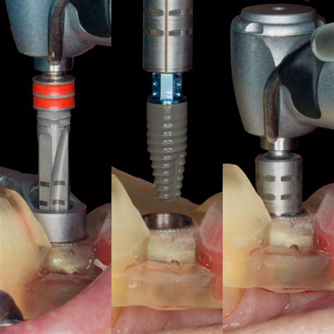 Implant Dentistry Courses Clear Dental