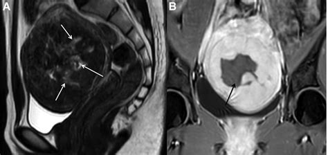 Sagittal T2-weighted MRI (A) shows the uterine fibroid with ...