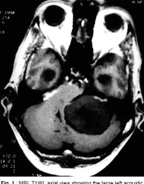 Figure 1 From Cavernous Sinus Thrombosis And Air Embolism Following Surgery For Acoustic