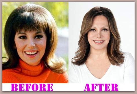 Marlo Thomas Plastic Surgery Before And After #MarloThomasPlasticSurgery #MarloThomas # ...