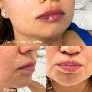 Lip Filler Migration What Does Migrated Lip Filler Look Like Dc