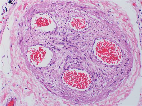 Complete Organization Of Thromboembolus With Recanalization A Photo On Flickriver