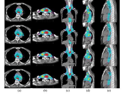 Deep Esophageal Clinical Target Volume Delineation Using Encoded D