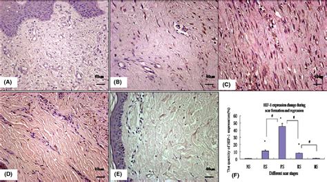 Figure 5 From Dynamic Hypoxia In Scar Tissue During Human Hypertrophic