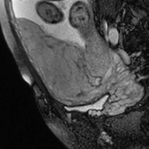 Sagittal Bffe Sequence Of Placenta Previa Totalis Without Invasive